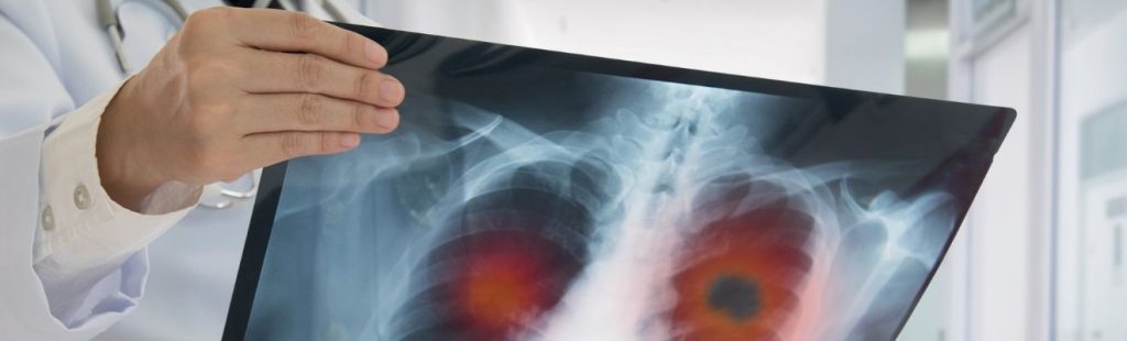 cáncer pulmón rayos x
